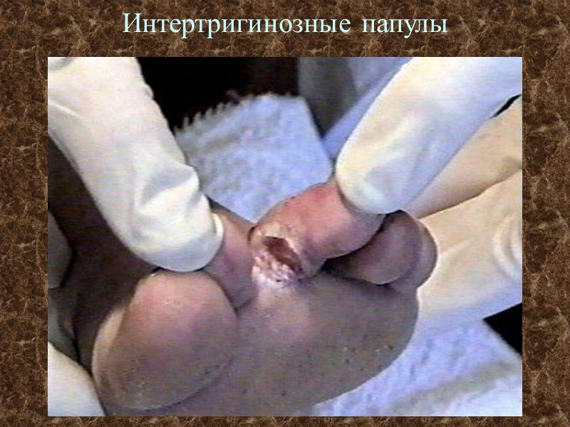 Интертригинозные папулы